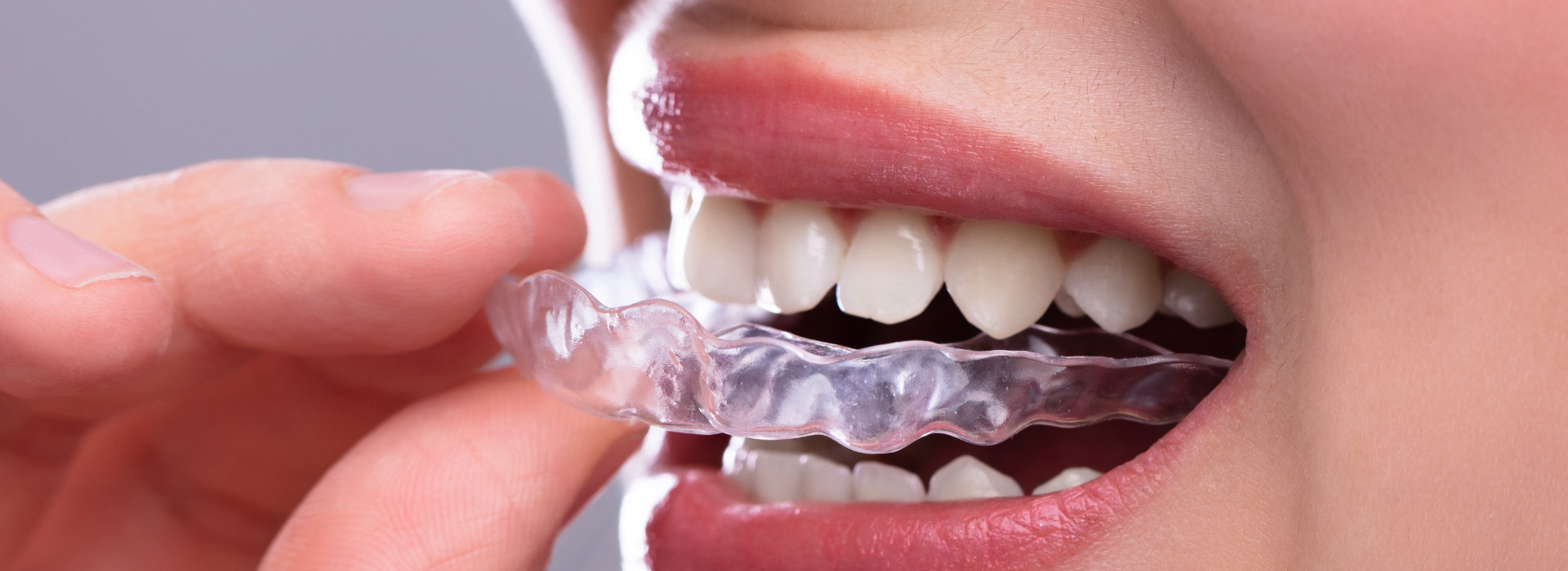 A woman is using clear aligners