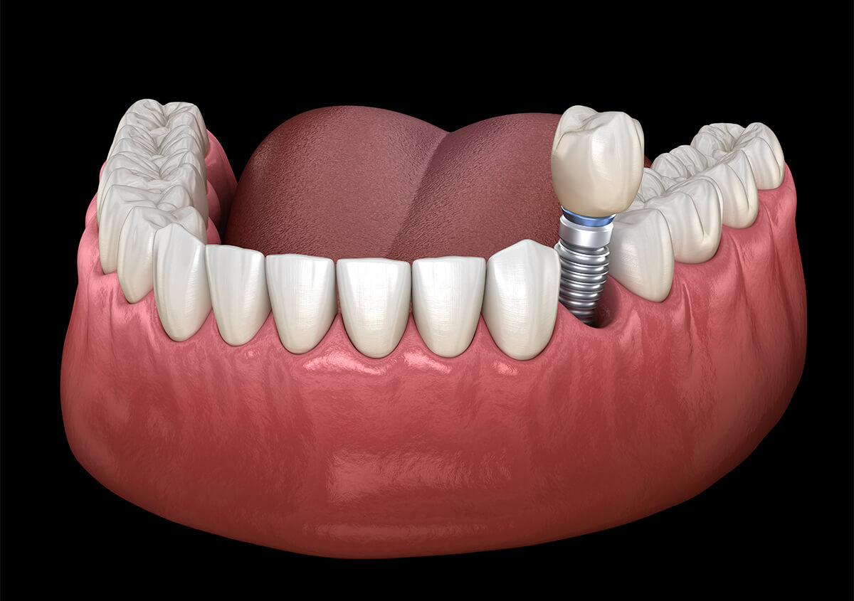 Teeth Implants in Riverside CA Area