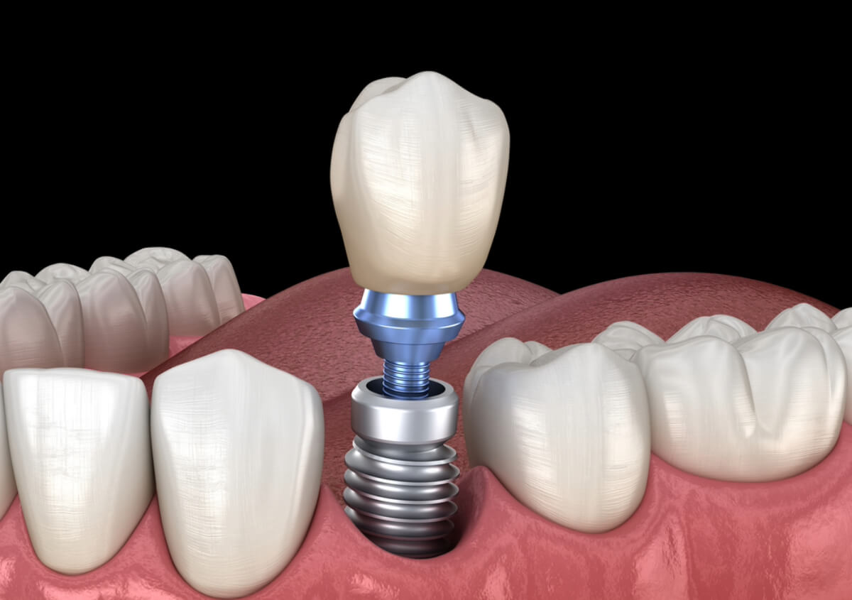 Dentist for Implants Riverside CA area