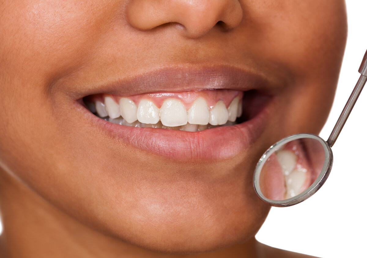 Teeth Whitening Options in Riverside CA area