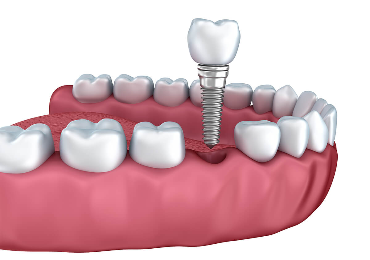 Good Dental Implants in Riverside CA Area